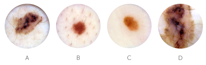 melanoma images