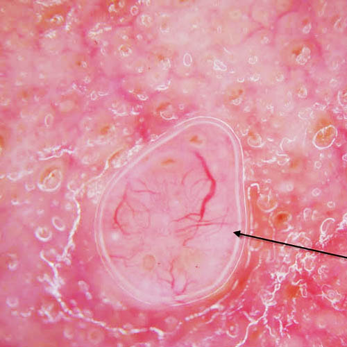 Basal Cell Carcinoma