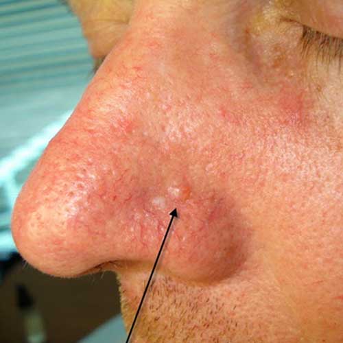 Basal Cell Carcinoma