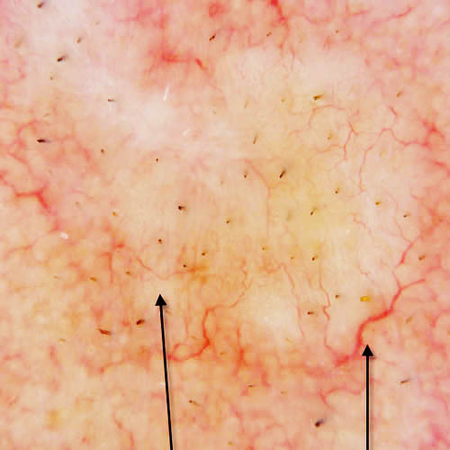 Basal Cell Carcinoma