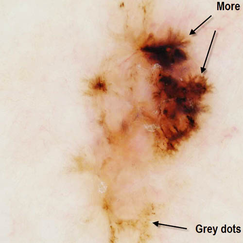 Basal Cell Carcinoma