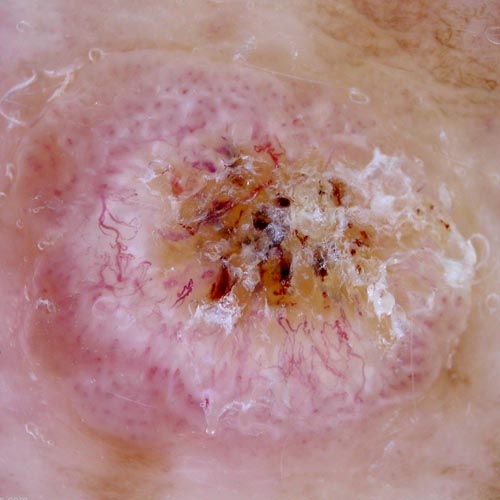 Squamous Cell Carcinoma