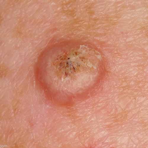 Squamous Cell Carcinoma