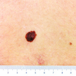 melanoma clinical image