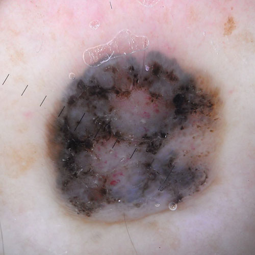 melanoma dermoscopic image