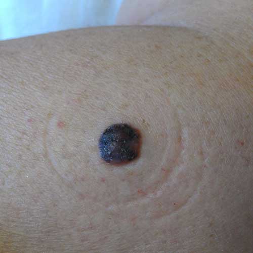 Blue Nevi Moles Pictures Photos