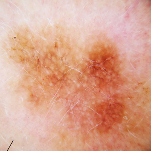 melanoma dermoscopic image